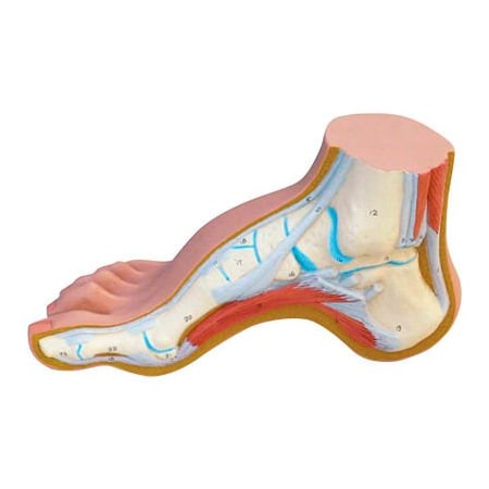 3B® Anatomical Model - Hollow Foot (Pes Cavus)